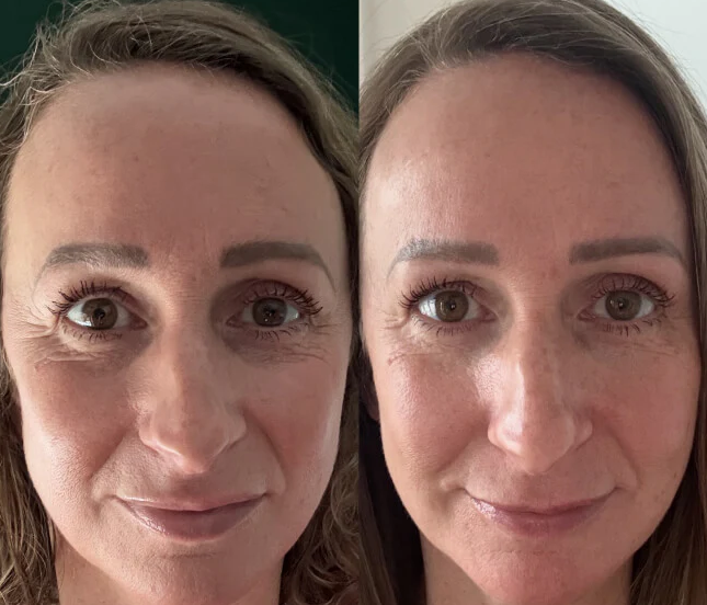 Before and after CollaReplen — customer results