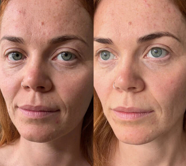 Before and after CollaReplen customer results