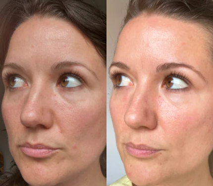 Before and after CollaReplen customer results